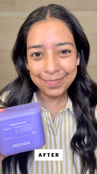 Foresto after using the Mediheal PDRN Lifting Pad